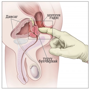 Digital_rectal_exam - Copy