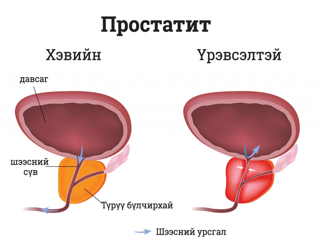 prostatitis_shutterstock_127210970-Converted - Copy