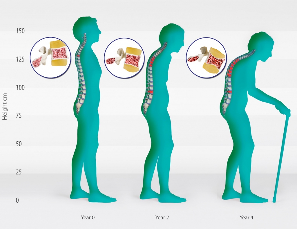 Osteoporosis+Stages