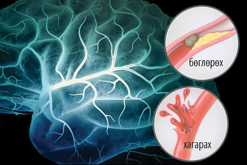 brain_stroke_symptoms - web