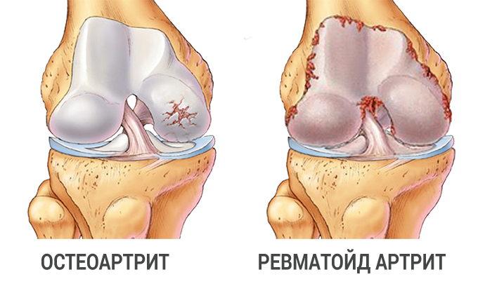 arthritis-knee