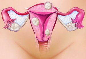 webmd_rf_photo_of_fibroids